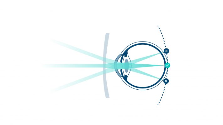 Herkömmliche Einstärkengläser korrigieren zwar die Kurzsichtigkeit, sind aber nicht darauf ausgelegt, das Fortschreiten zu verlangsamen