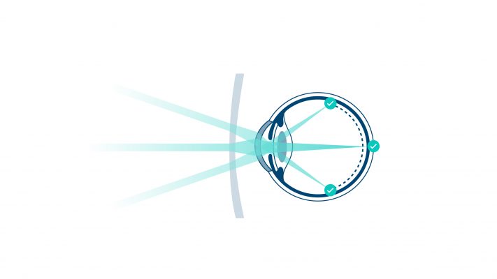Die besondere Brillenglasberechnung von Rodenstock MyCon sorgt für die Korrektur der Fehlsichtigkeit und trägt dazu bei, dass die Kurzsichtigkeit nicht unkontrolliert fortschreiten kann: Das Licht wird an den Rändern gestreut, so dass es bereits vor der Netzhaut auftrifft. So wird das Längenwachstum der Augen verlangsamt.